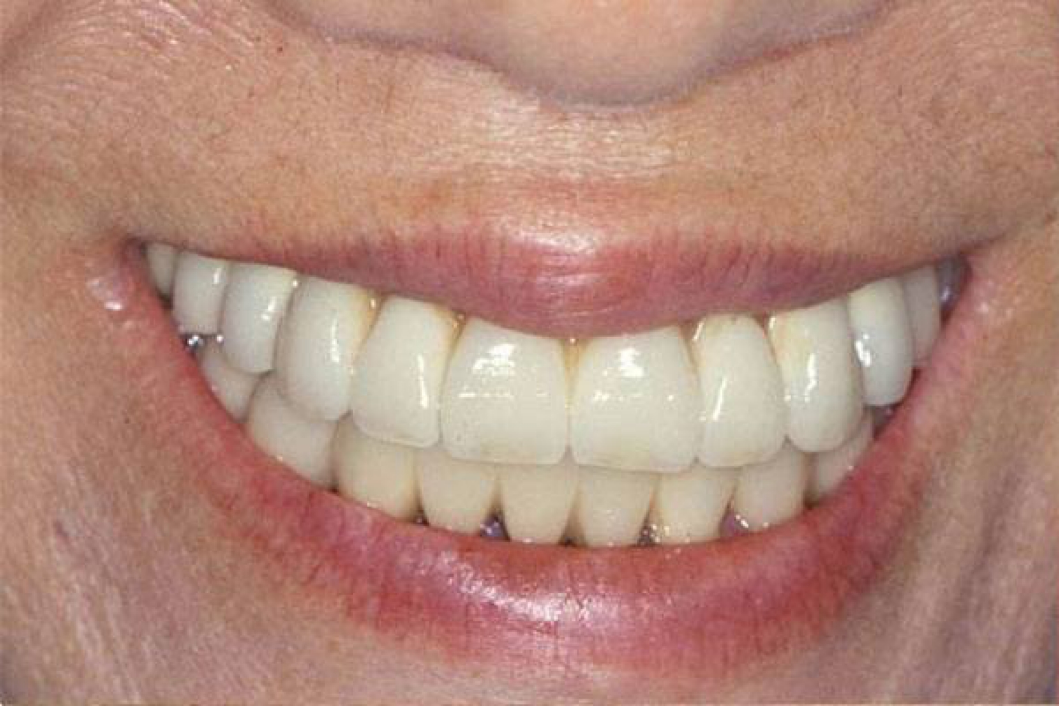 This patient received a full-mouth rehabilitation of both upper and lower arches with implant-supported bridges.