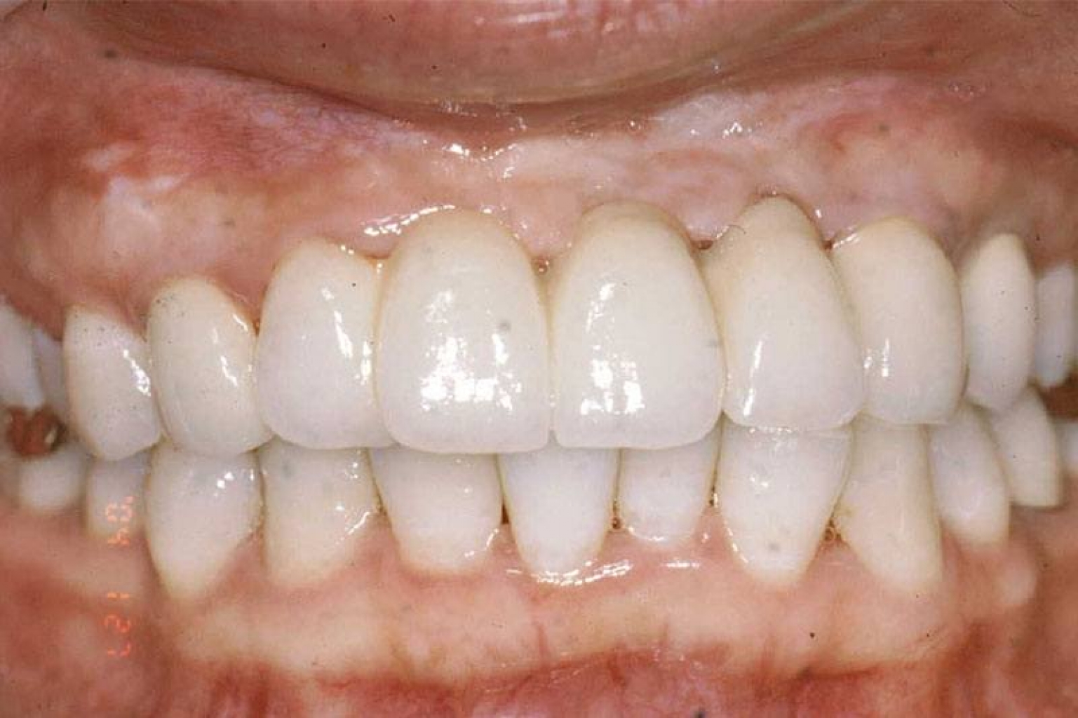 This patient’s upper seven teeth were restored using four implants and an implant-supported bridge.