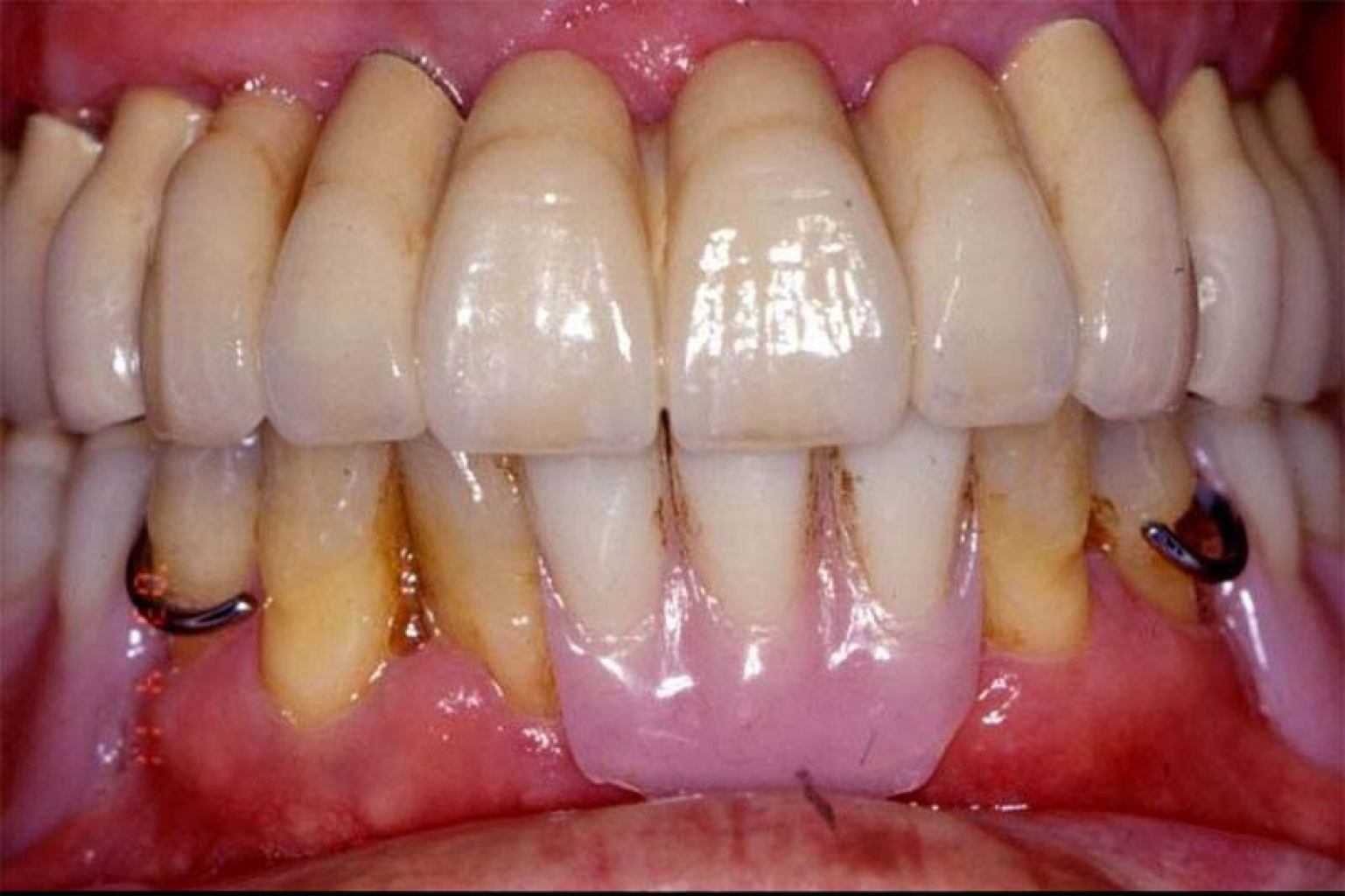 The patient’s smile was restored using three separate implant-supported bridges. He also required a partial bottom denture.