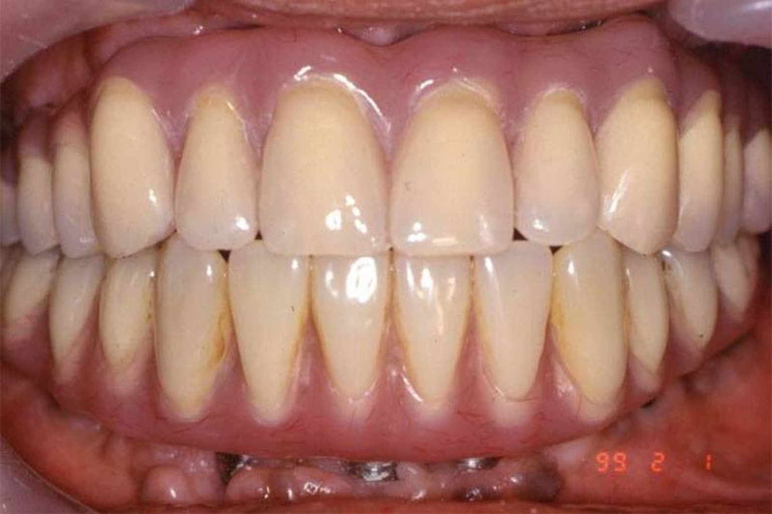 This patient received her smile restoration with fixed but detachable plastic acrylic dentures.
