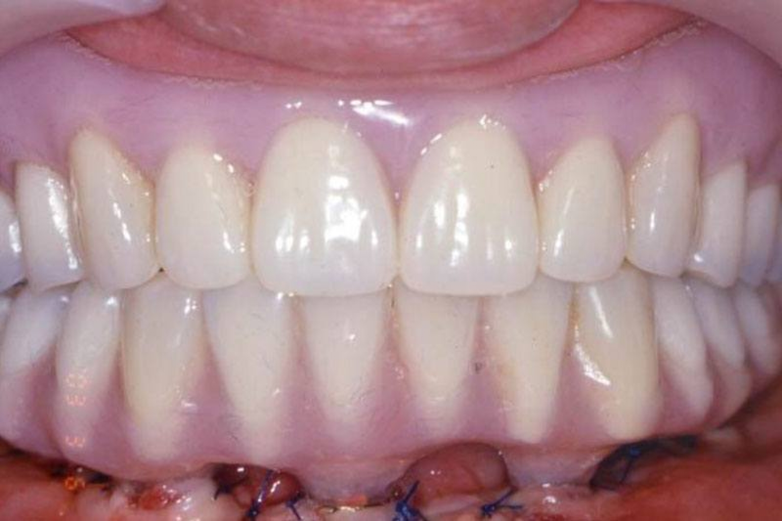 Our new patient came to us with an emergency issue. Dr. Choi fixed his issue chairside by restoring his existing dentures to ensure comfort and full range of utilization. Within a few short hours, he was happy and out the door issue-free!