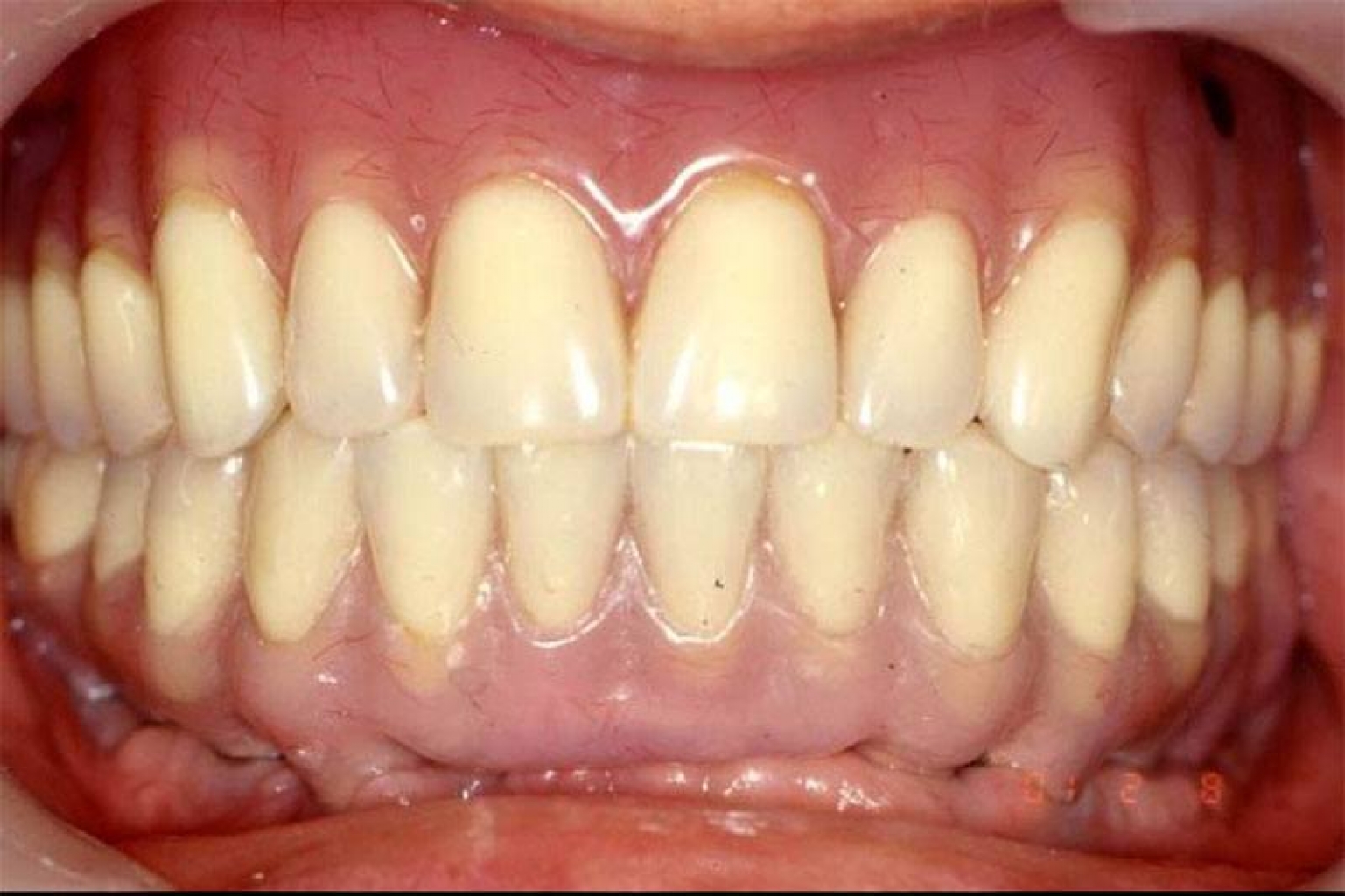 To achieve a picture-perfect smile, Dr. Choi used a fixed bottom hybrid/detachable denture with a metal frame wrapped in acrylic. The patient received a full-mouth restoration with upper implant supported over dentures.